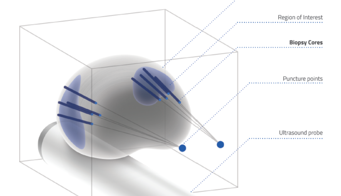 ဆီးကျိတ်ကင်ဆာရှိသည့်နေရာကို စက်ဖြင့်ချိန်ရွယ်ပြီးအသားစယူခြင်း။