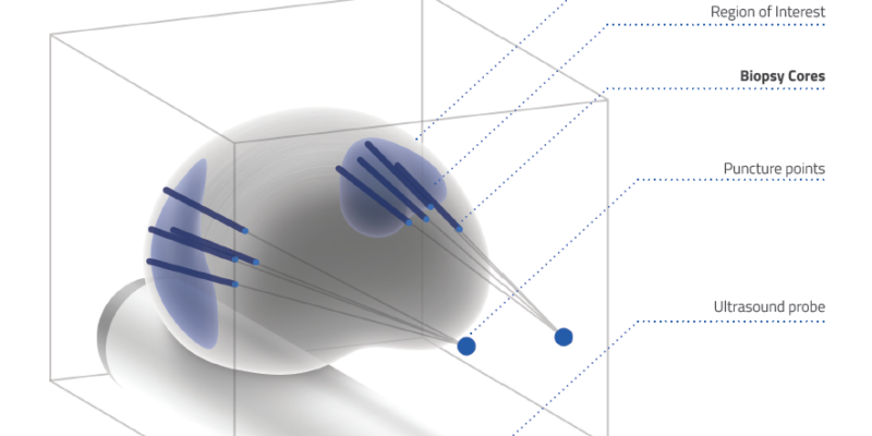 ဆီးကျိတ်ကင်ဆာရှိသည့်နေရာကို စက်ဖြင့်ချိန်ရွယ်ပြီးအသားစယူခြင်း။